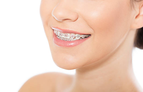 dental braces Adelaide