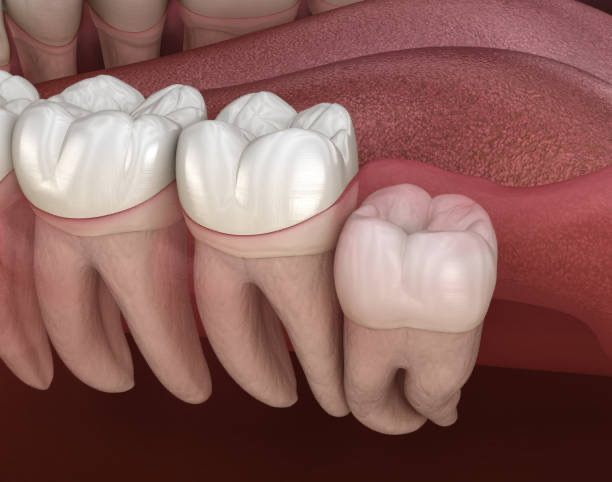 wisdom teeth removal Adelaide