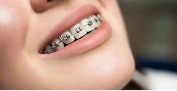 dental braces Adelaide